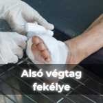 Alsó végtag fekélye