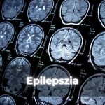 Epilepszia