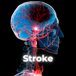 Stroke